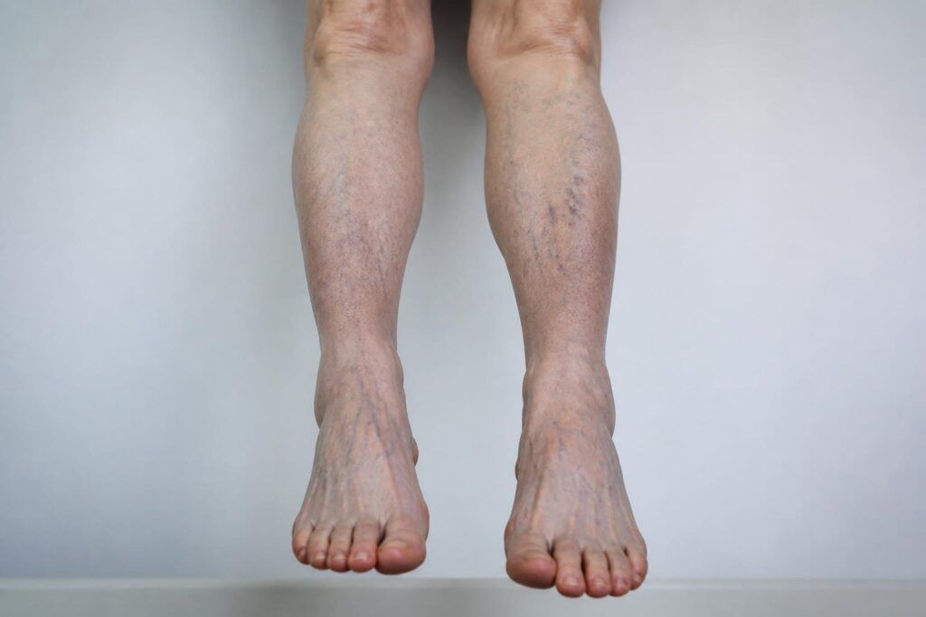Bleu sur les jambes : que révèle cette marque sur votre circulation sanguine ?