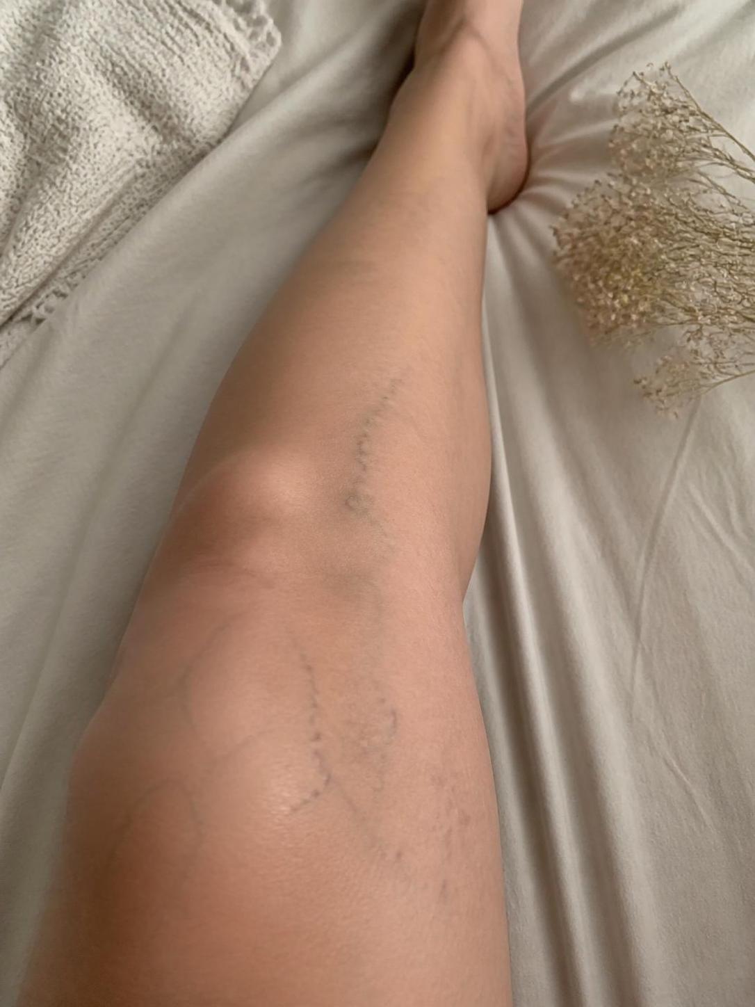 découvrez ce que signifie la présence de taches bleues sur vos jambes et ce qu'elles révèlent sur la santé de votre circulation sanguine.